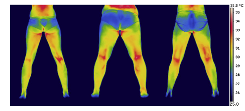 cirugía ligamento termografía